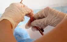 سرم خون بند ناف انسانی تولید شد/کاربرد در ترمیم قرنیه و پوست