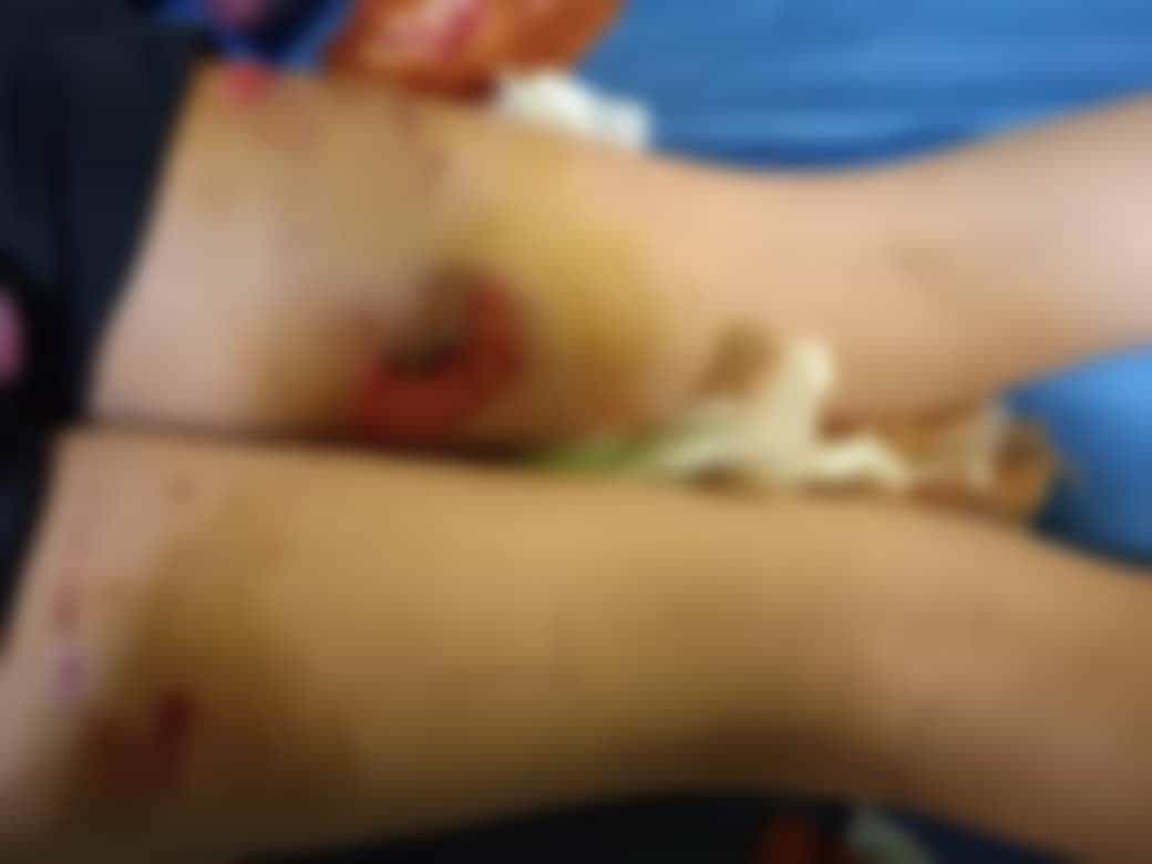 حمله سگ های بلاصاحب به کودک ۱۱ ساله در حومه تبریز