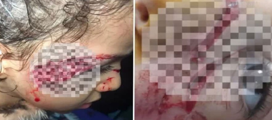 حمله سگ‌های ولگرد به جان کودک ۵ ساله در تبریز
