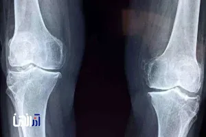 امید تازه برای درمان آرتروز