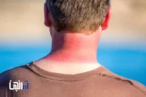 مراقب آفتاب‌سوختگی باشید!